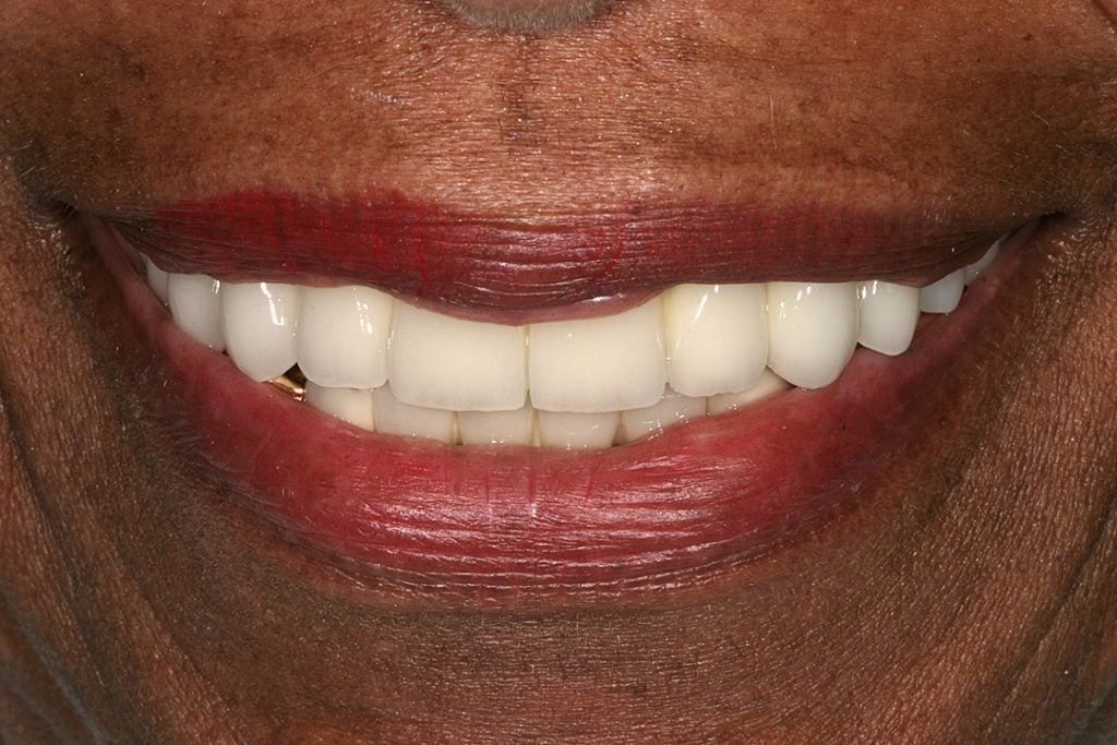 Teeth whitening georgetown dc