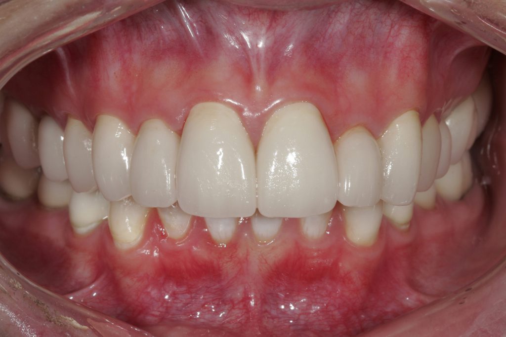 Before & After Dental Photos Vienna VA | Washington DC ...